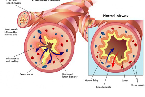 Asthma-Bronchiale